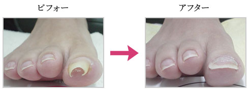 巻き爪矯正の矯正前後の様子